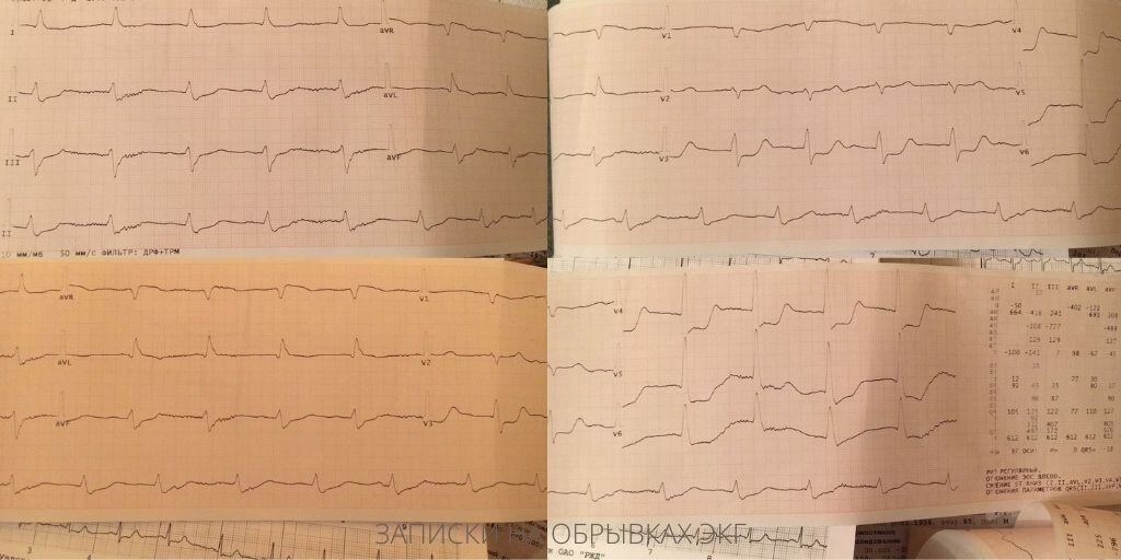 ЭКГ дедушки. На первой картинке - нами снято, а на второй - в поликлинике. 