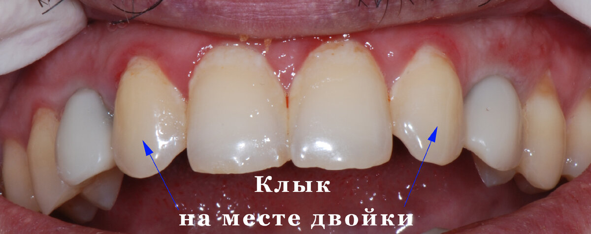 Что делать, если нет зачатков постоянных зубов, а молочные клыки так и ...