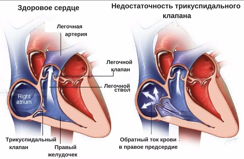 Трехстворчатый клапан Трехстворчатый клапан