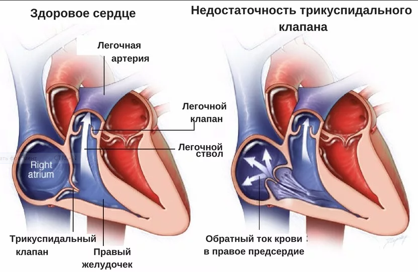 Недостаточность трехстворчатого клапана презентация