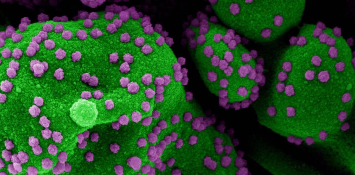 Инфицированная вирусными частицами SARS-COV-2 (сиреневым цветом) человеческая клетка (зеленым цветом), находящаяся в процессе апоптоза. Сканирующая электронная микроскопия. Credit: NIAID