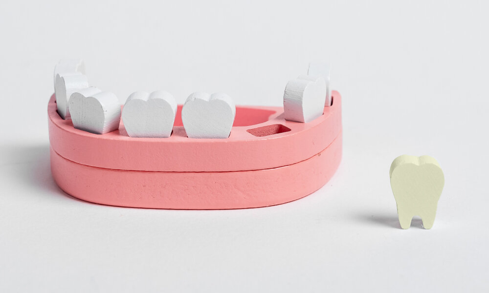    Зубы мудрости: почему врачи советуют их удалять (фото 2)