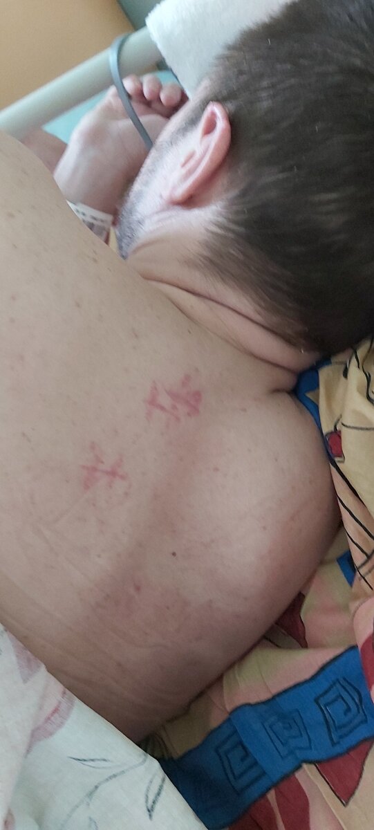 Следы от ножевых ранений, зажившие