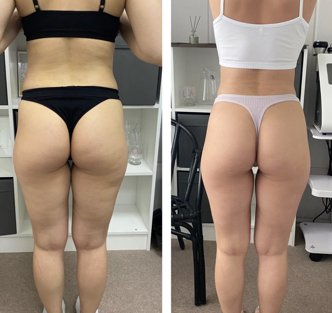 Результат от 1 курса аппаратного массажа (7 процедур)