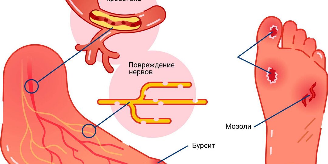 Диабетическая стопа. Причины и профилактика.