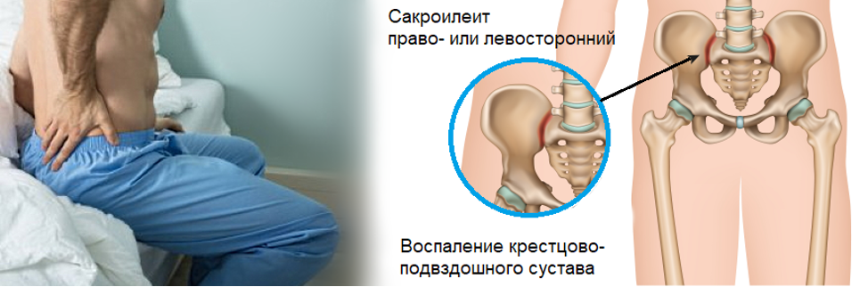 Воспаление подвздошных суставов