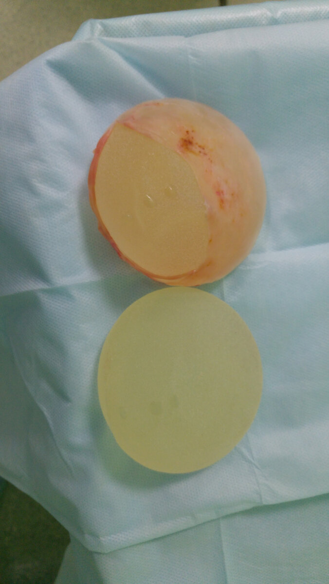 Первый имплант извлекли из пациентки. Второй - новый - установили