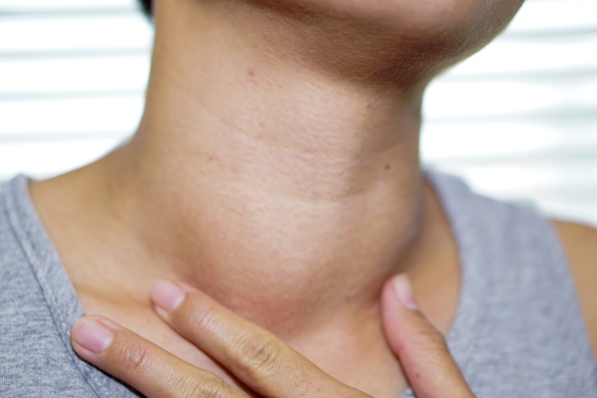 Толстая шея признак. Увеличенная щитовидная железа. Припухлость щитовидки.