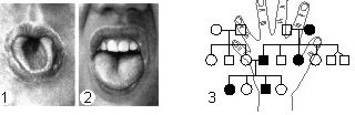 Доминантный признак — способность свертывать язык в трубочку (1) и его рецессивный аллель — отсутствие этой способности (2). 3 — родословная по полидактилии (аутосомно-доминантное наследование).