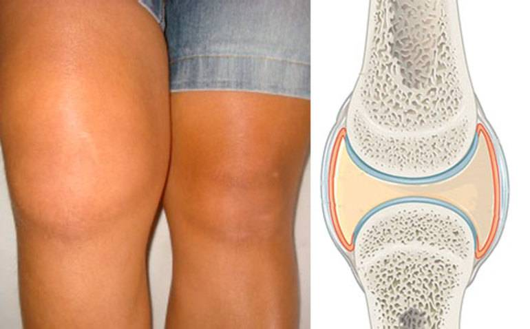 Почему отекаешь после массажа. Синовит коленного сустава. Препателлярный бурсит. Что такое синовит коленного коленного сустава.