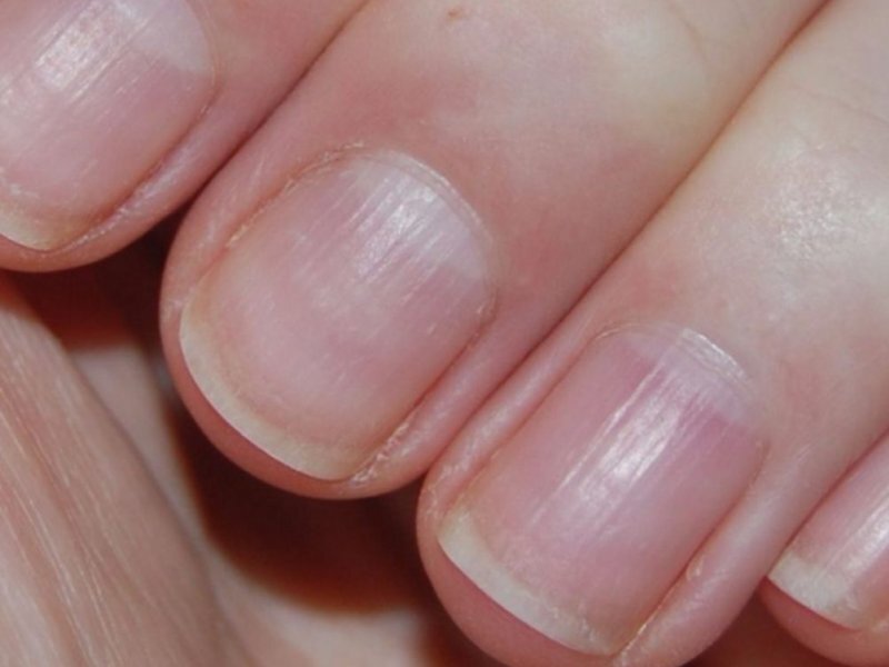 Вертикальные полоски на ногтях.