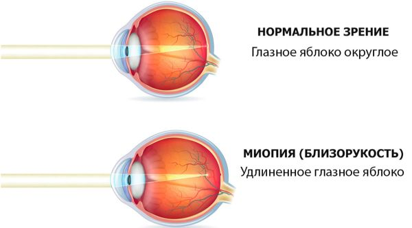 осевая миопия связана с избыточным ростом глазного яблока