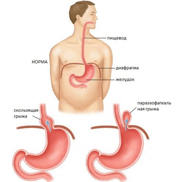 Расслаблен желудок. Грыжа пищеводного отверстия пищевода симптомы. Диафрагмальная грыжа пищевого отверстия. Грыжа пищевода отверстия диафрагмы.