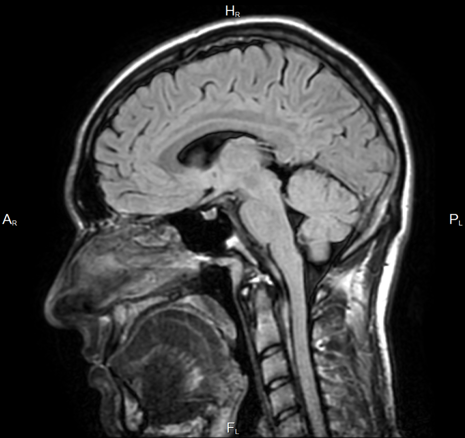 мрт головного мозга при мультисистемной атрофии. аноксическое поражение головного мозга мрт. краниофарингиома это опухоль. кавернозная ангиома мрт.