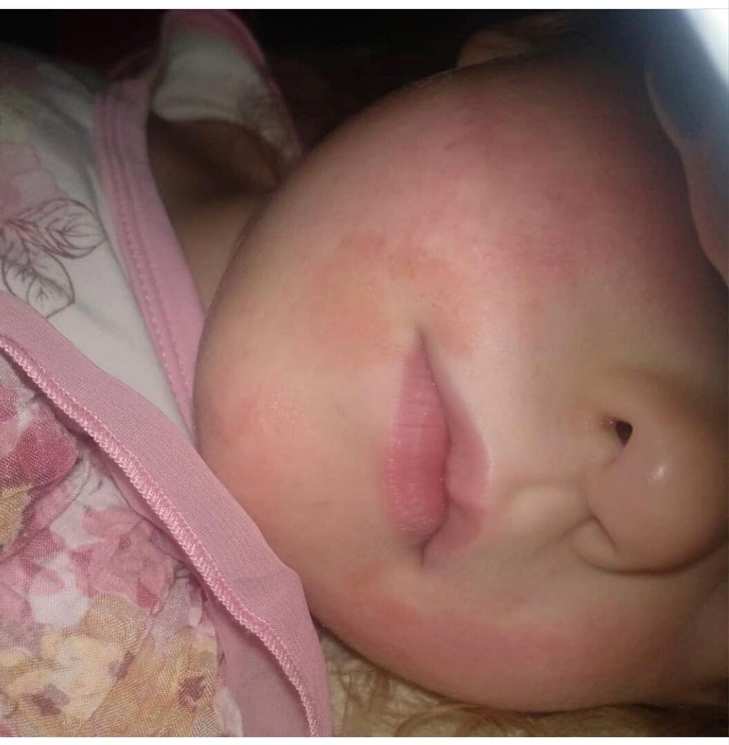 детская аллергия