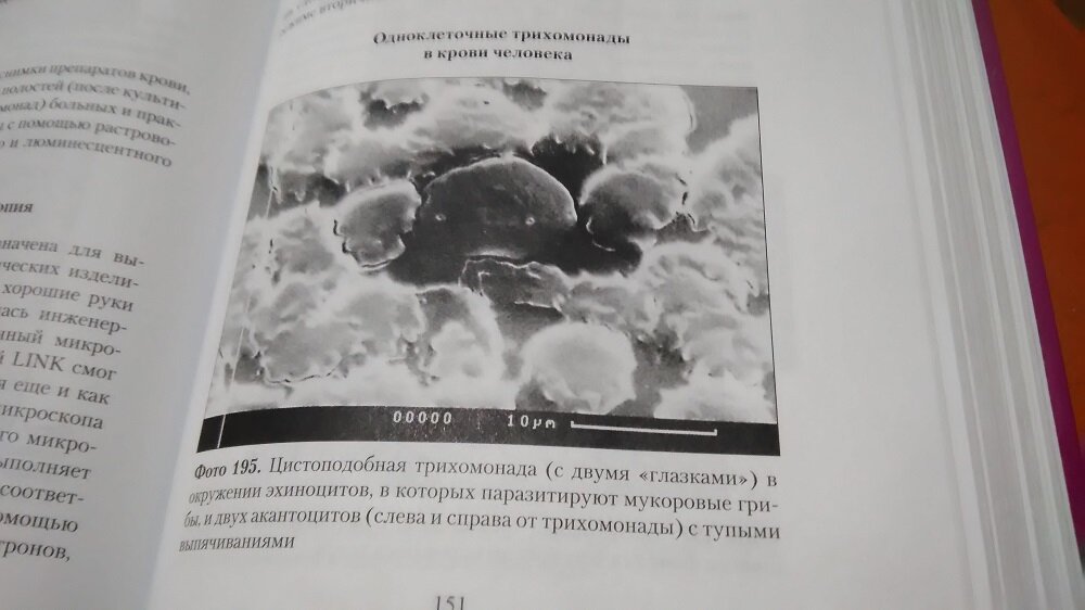 "Метастаз" - Цистоподобная трихомонада под микроскопом. Снимок из книги Диагностическая микроскопия. Свищёва Т. Я.