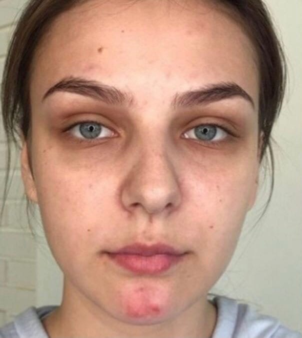 Избавиться от темных кругов вокруг глаз быстро реально.