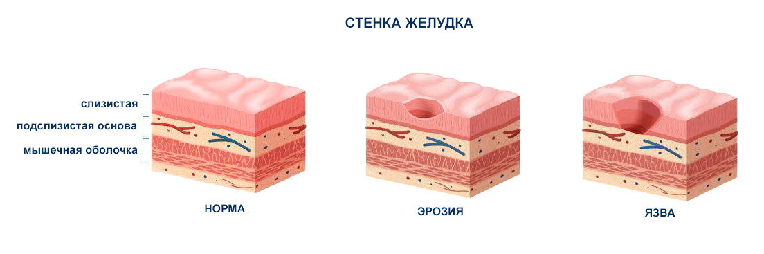 Эзофагогастродуоденоскопия (видеогастроскопия) в Киеве