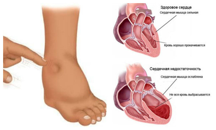 Отеки ног при сердечной недостаточности у пожилых людей