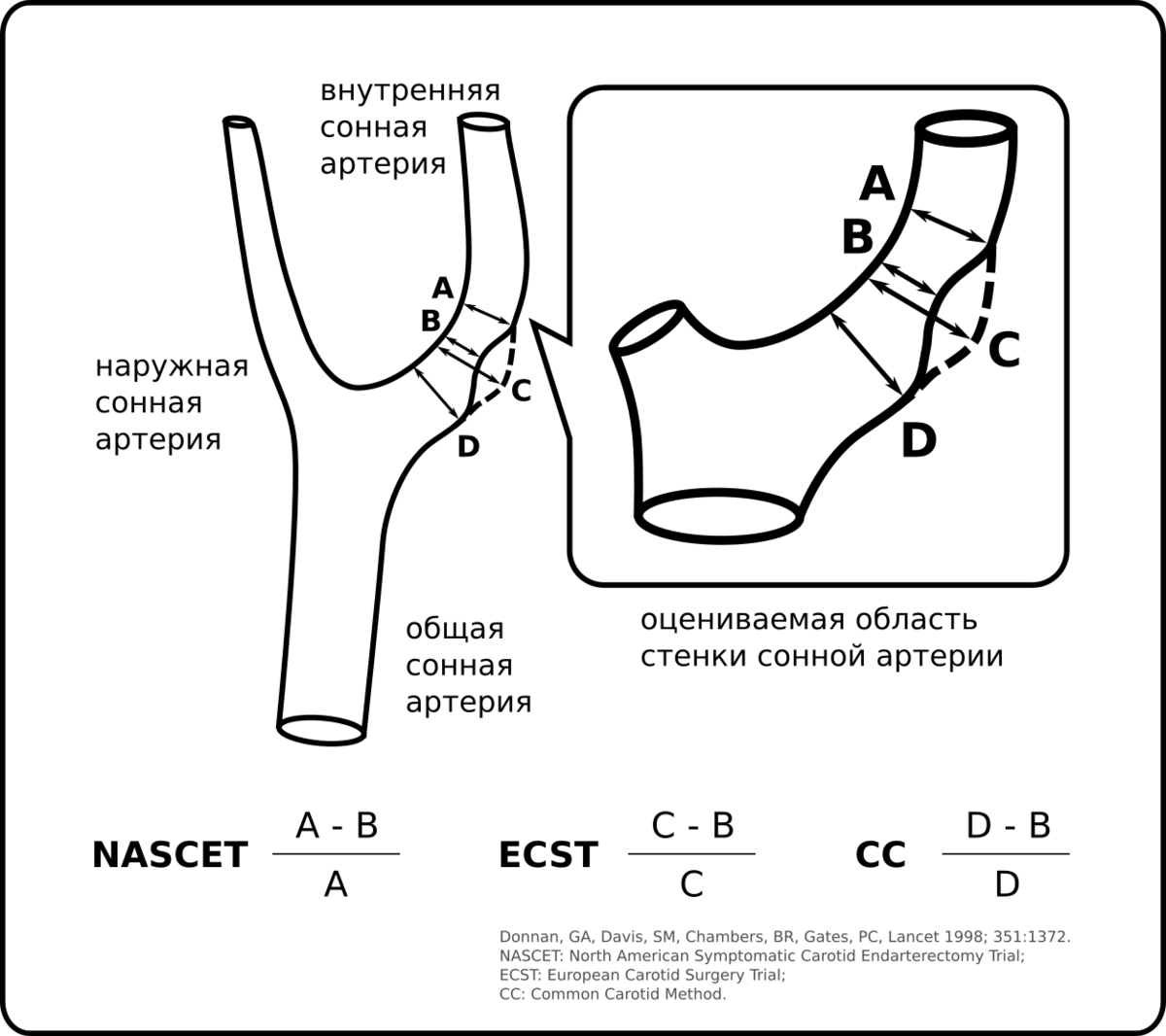 Атеросклероз сонных артерий и ишемический инсульт