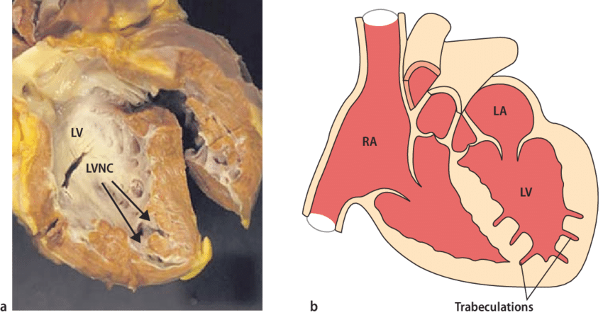 Некомпактный миокард левого желудочка сердца. Вскрытие.