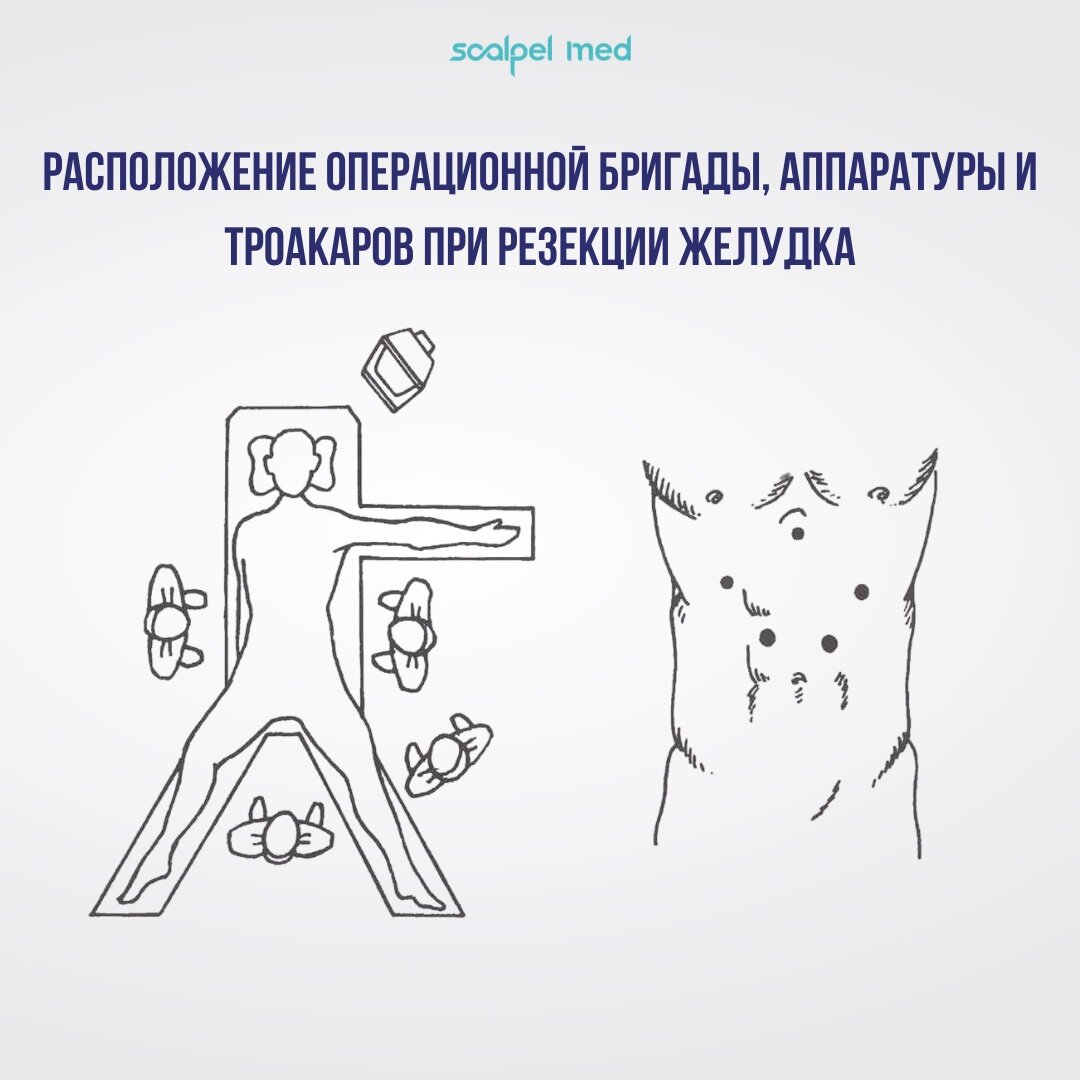 Расположение операционной бригады, аппаратуры и троакаров при резекции желудка