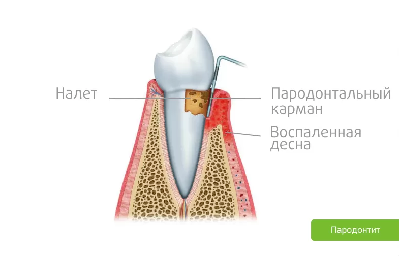 Десневой борозде. Пародонт.