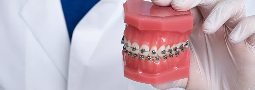 Брекеты — наиболее эффективное средство испрвления неровных зубов и неправильного прикуса.