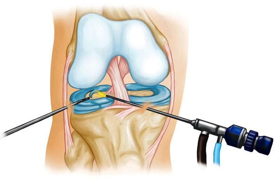 Артроскопия коленного сустава. Операция артроскопия коленного сустава. Артроскопическая менискэктомия коленного сустава. Разрыв мениска коленного сустава операция. Операция артроскопия коленного сустава мениска.