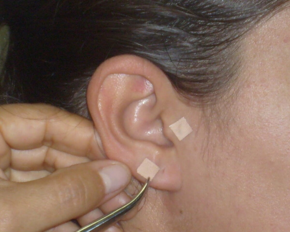 Врач-специалист ставит маленькие иголочки-вензеля в уши, после стимуляции которых должно пропадать желание перекусить