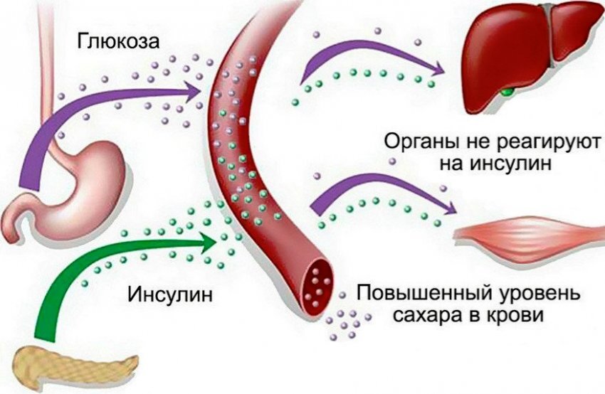 Сахарный диабет 2 типа