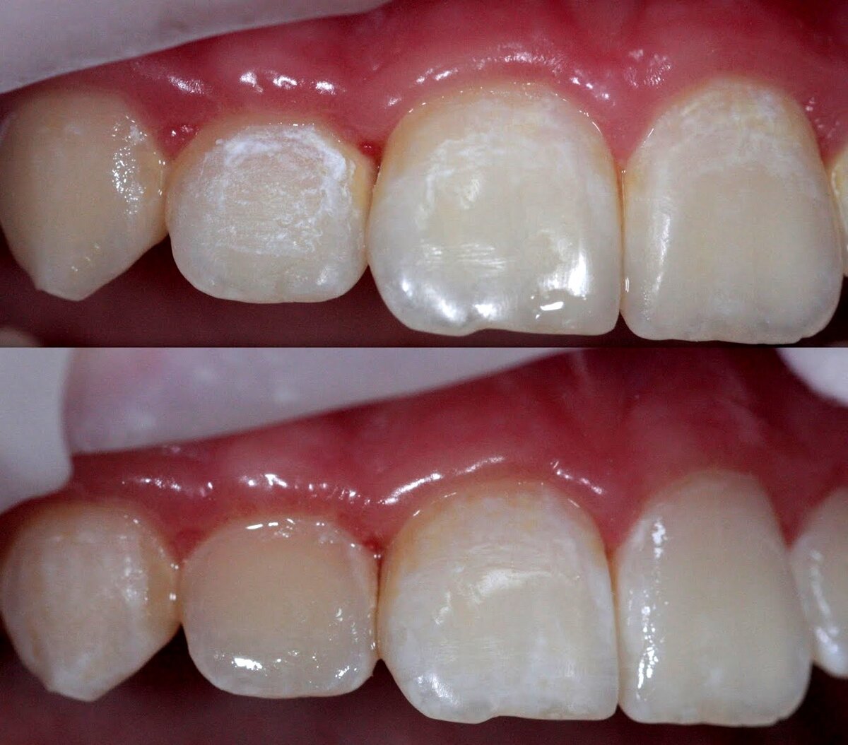 Очаги деминерализации эмали вокруг брекетов