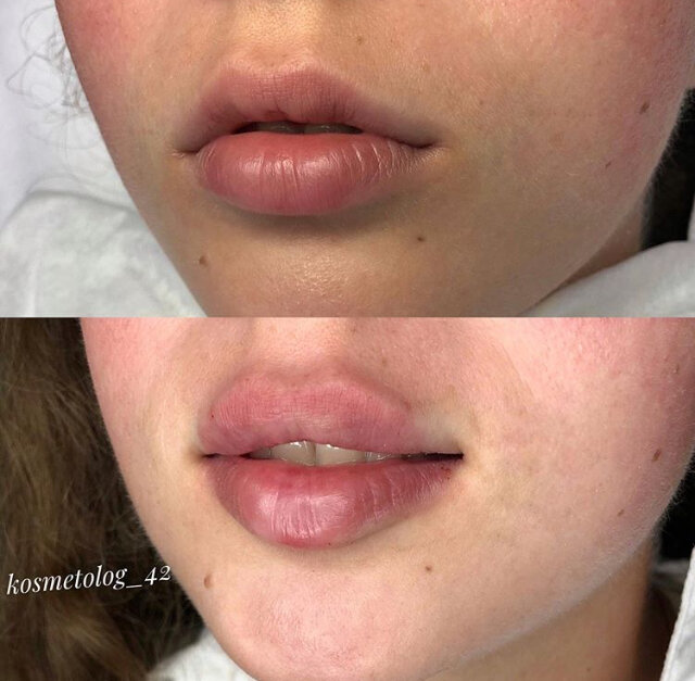 мои губы до и после 