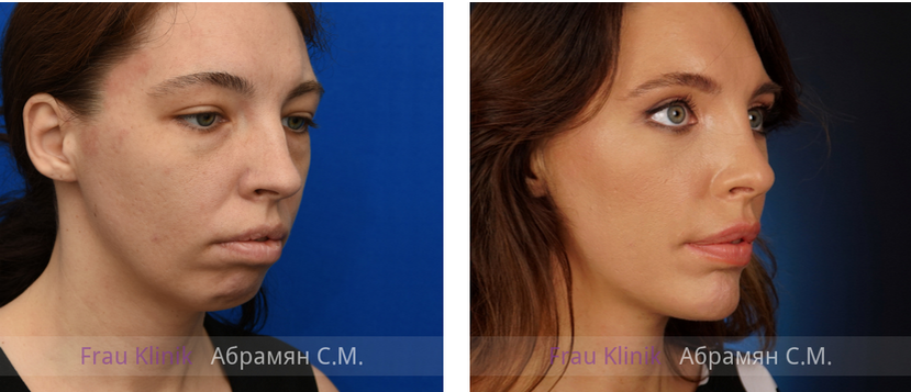 Имиджевая пластика: фото ДО и ПОСЛЕ операции