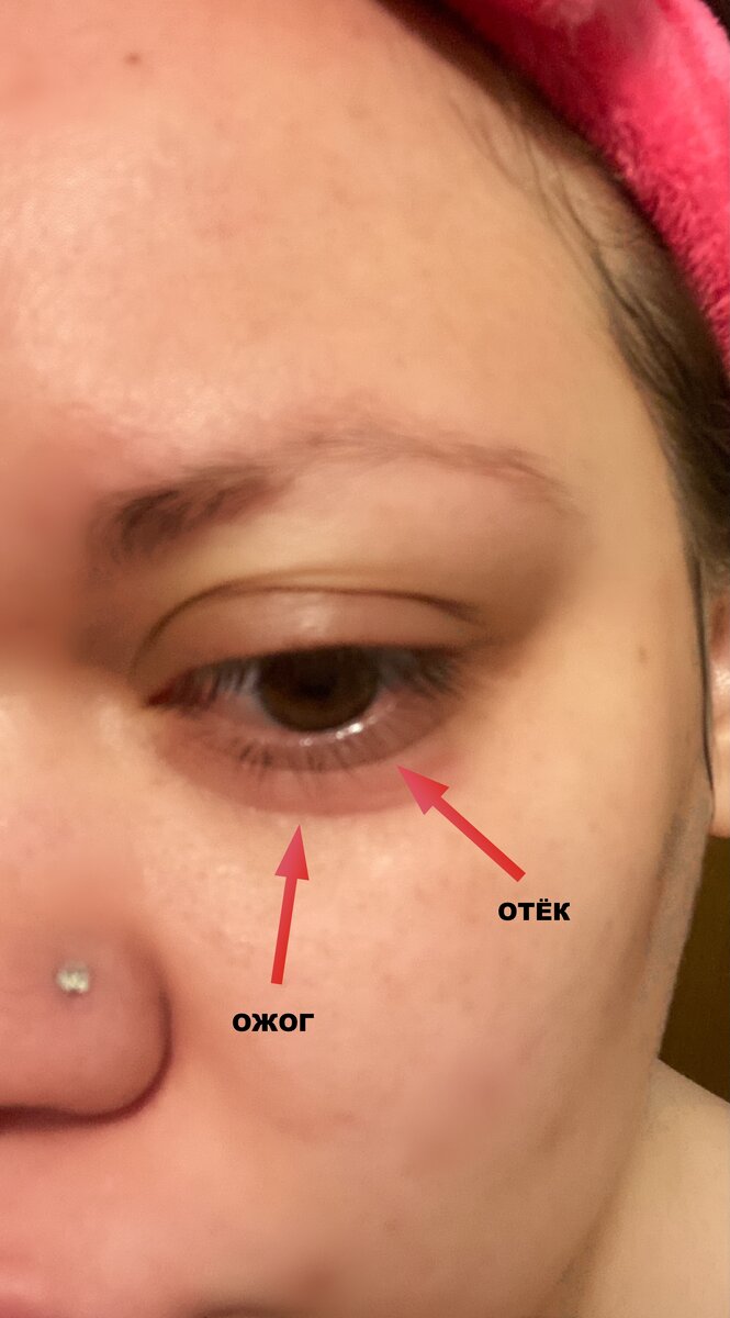 Камера сильно "теплит" и не передаёт красноты глаза. На третьи сутки кожа начала слезать, что говорит о химическом повреждение. Фото прикладывать не буду, потому что зрелище не из приятных.