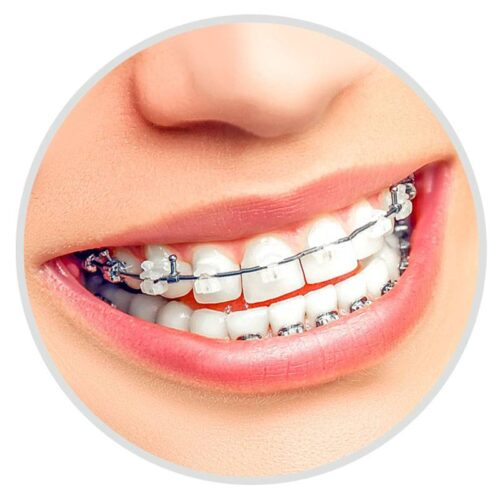 Брекет система