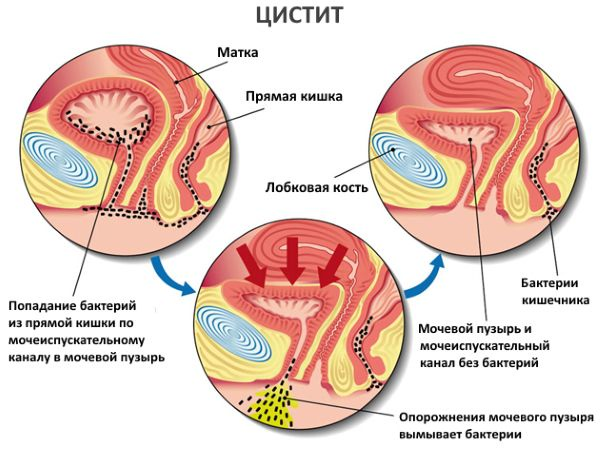 Боль в уретре