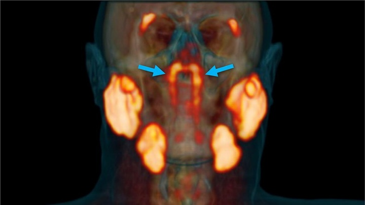 Новая пара слюнных желёз на томограмме. Иллюстрация M. H. Valstar et al./ Radiotherapy and Oncology (2020).