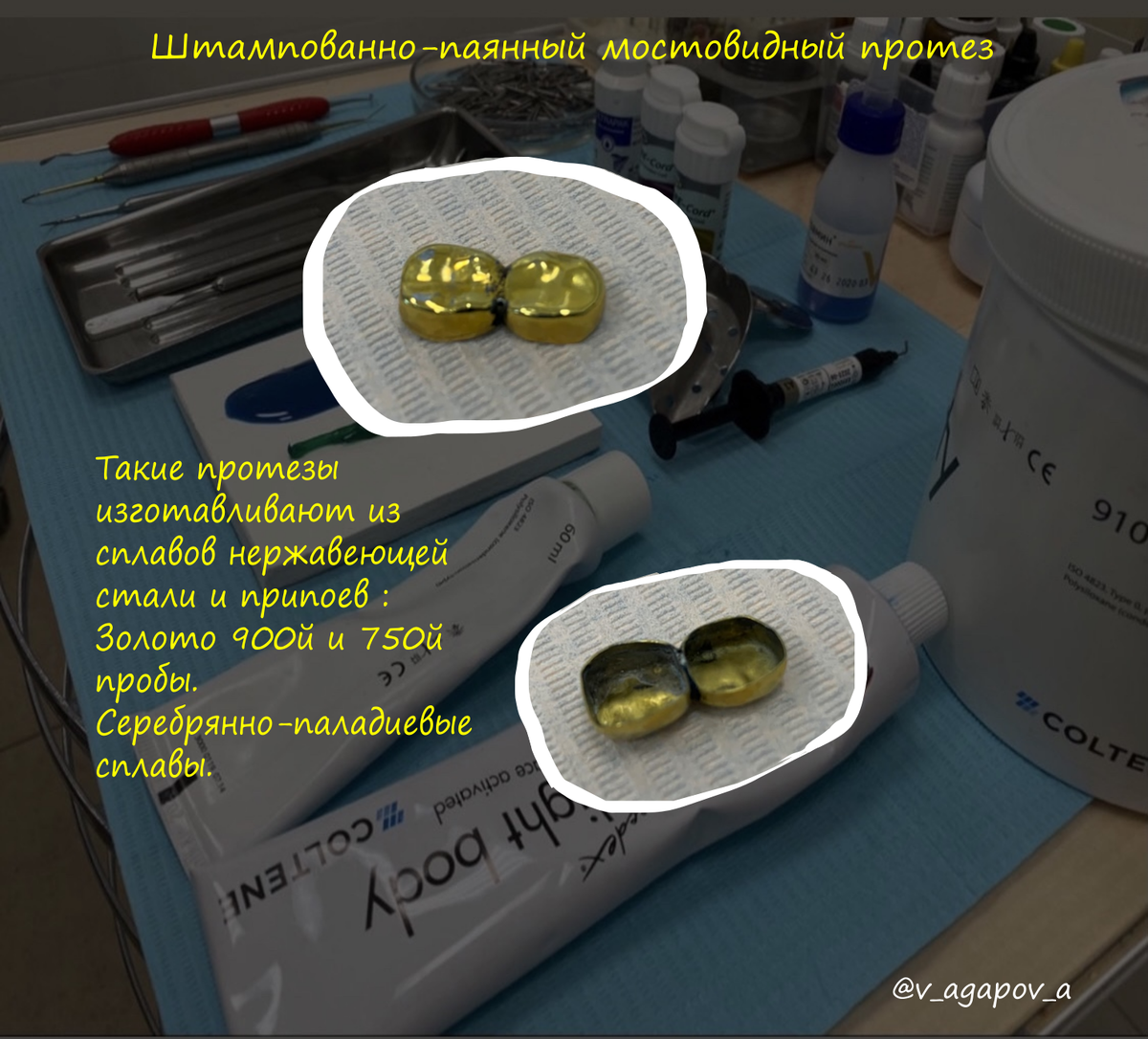 Спаянные коронки для жевательной группы зубов
