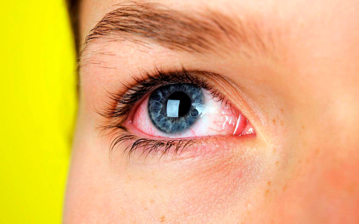 Покраснение белков глаз