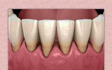 Источник - https://ed-m.ru/Poleznye-statqi/Xirurgija/Recessija-desen-simptomy-i-prichiny