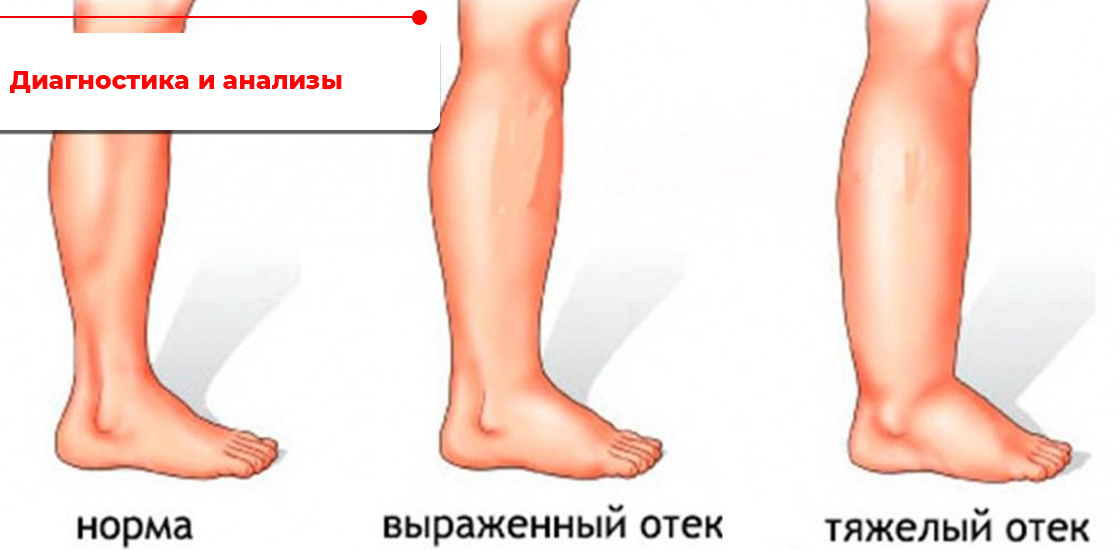 Отечность нижних конечностей. Отеки нижнихонечносте.