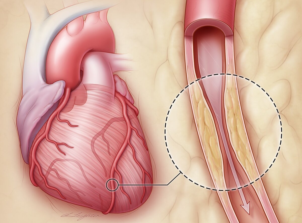 Ишемическая болезнь сердца фото