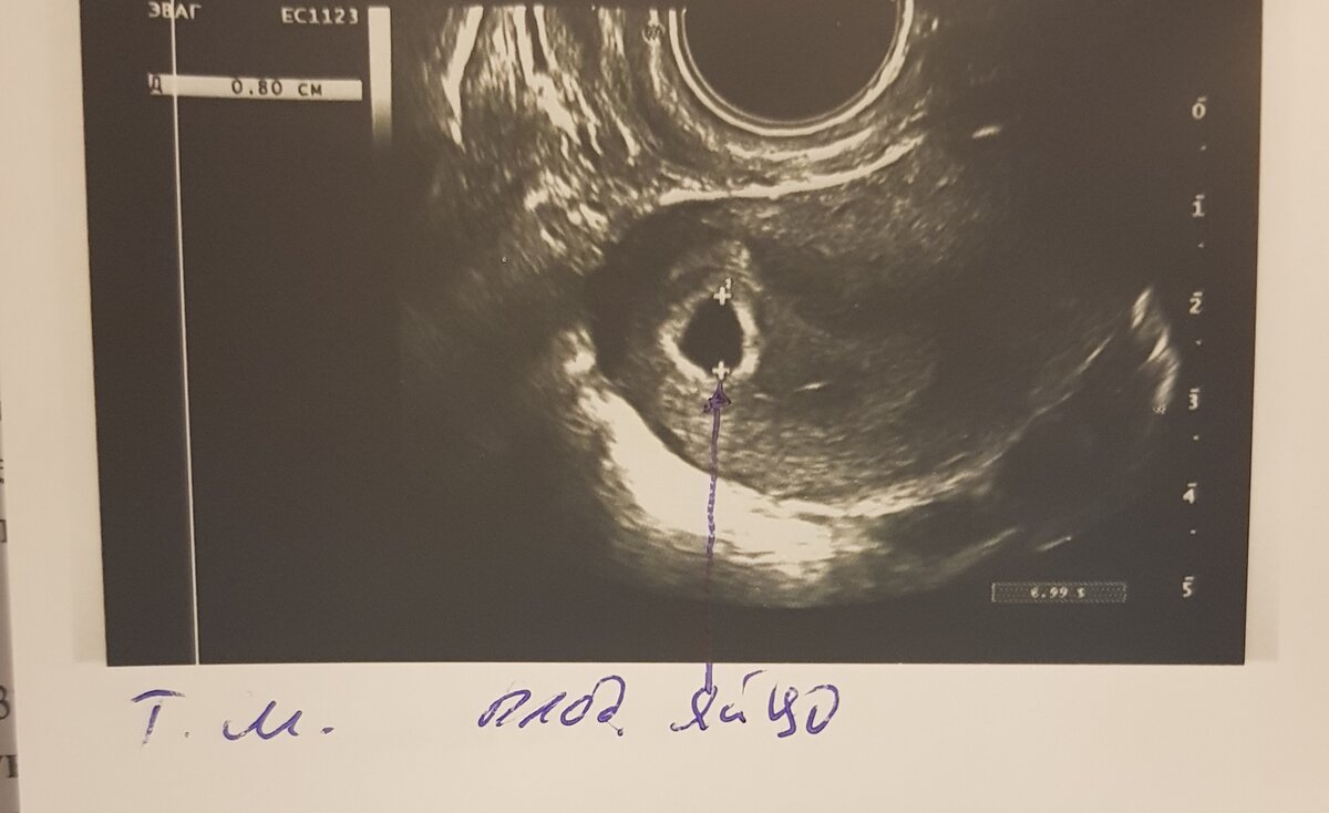 Личное фото из архива, плодное яйцо без эмбриона, срок 5-6  недель   