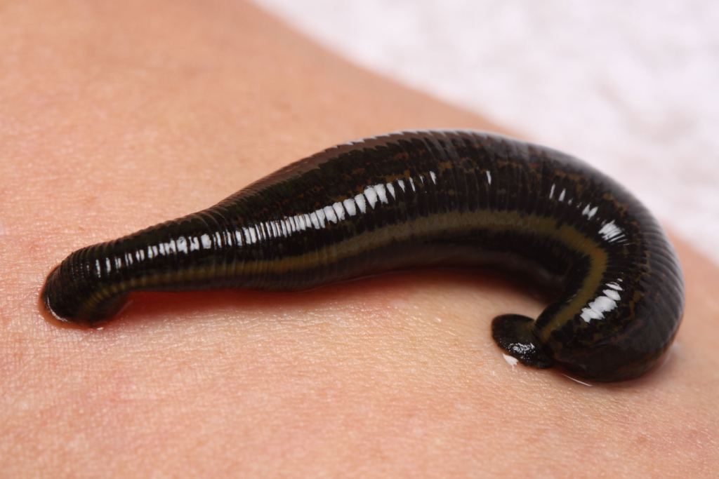 Гирудотерапия