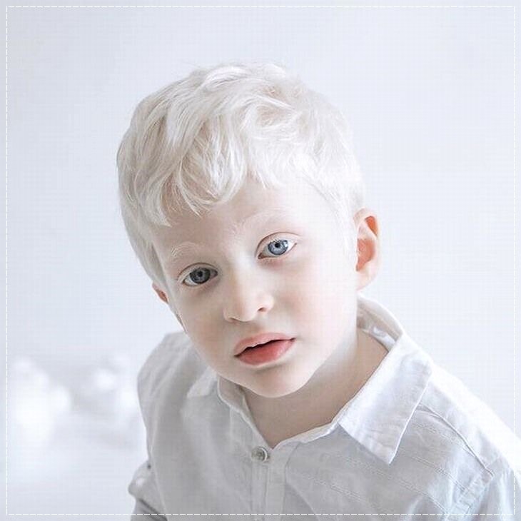 Альбинизм у человека глаза. Окулокутанный альбинизм. Тотальный альбинизм. Саша Смирнов альбинос.