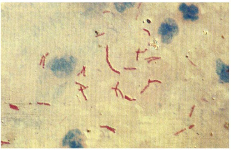 Микобактерия туберкулёза при окраске по Цилю-Нильсену (палочки тёмно-красного цвета). Источник: ppt-online.org