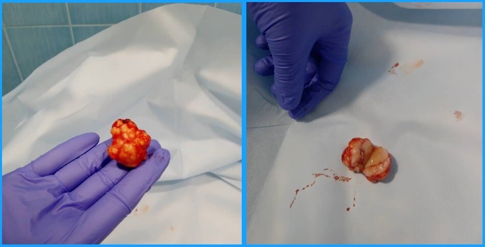 Фиброаденома. Риск 2-7% | Доктор Мухаметнуров | Дзен
