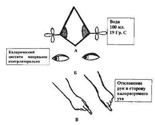 Клин руки. Калорическая проба нистагм. Схема этапов проведения калорической пробы.. Проведение калорической пробы что это. Калорическая вестибулярная проба.