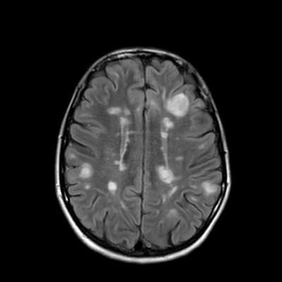 Syndrome of mild encephalopathy with a reversible splenial corpus callosum lesion